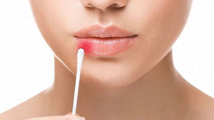 8 способов избавиться от герпеса за один день 8 способов избавиться от герпеса за один день