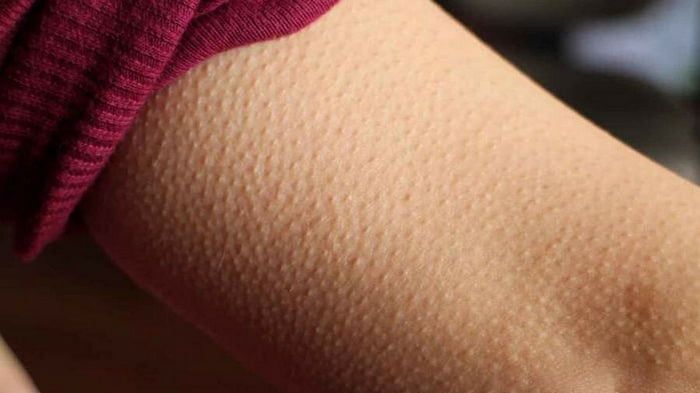 Гусиная кожа: почему возникает фолликулярный кератоз и как с ним бороться