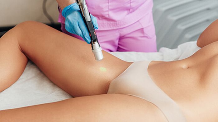 Лазерная эпиляция бикини: особенности процедуры