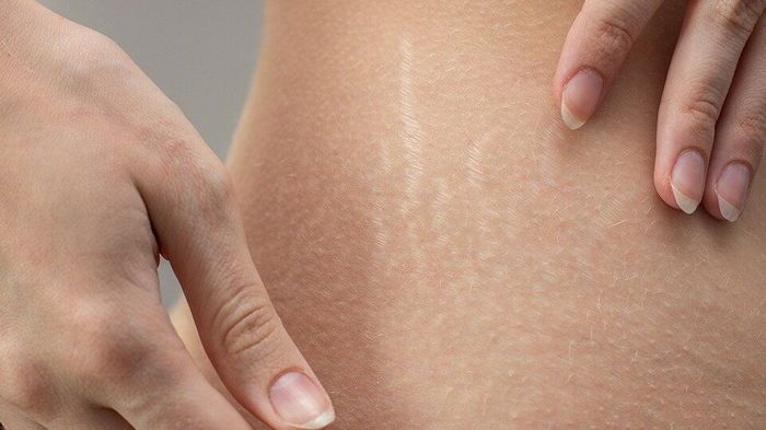 Эффективный и проверенный рецепт от растяжек Эффективный и проверенный рецепт от растяжек