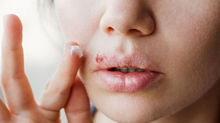 Почему на губах появляется простуда и чем ее лечить