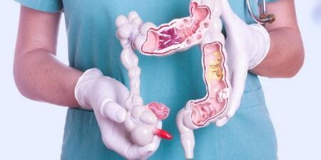 Рак товстої кишки (колоректальний рак)