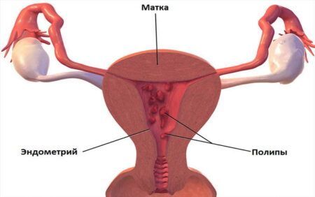 Полип шейки матки: что это за патология?