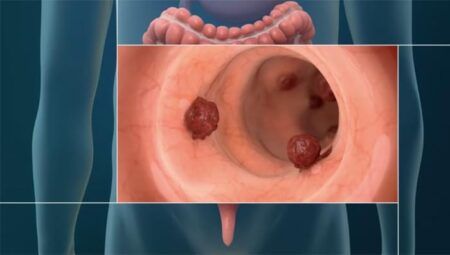 Рак товстої кишки (колоректальний рак)