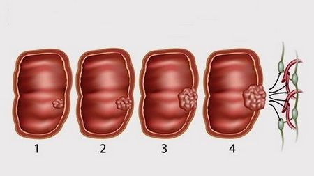 Рак товстої кишки (колоректальний рак)