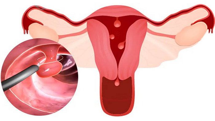 Полип шейки матки: что это за патология? Полип шейки матки: что это за патология?