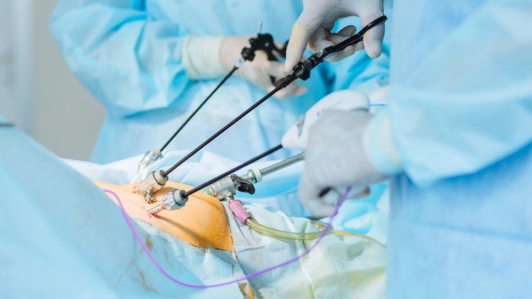 Удаление желчного пузыря — лапароскопическая холецистэктомия