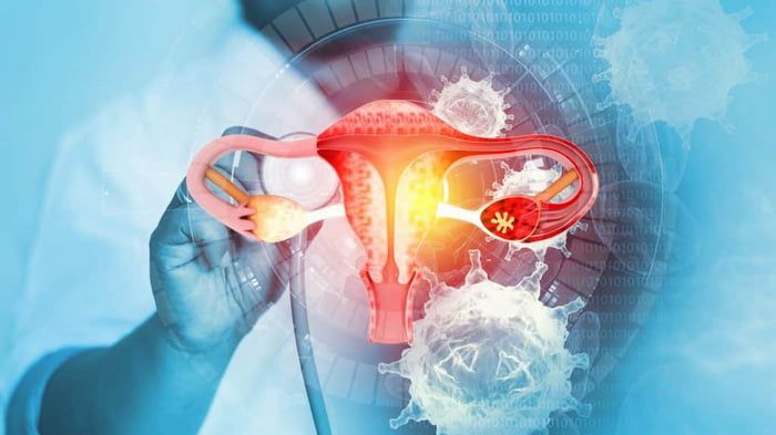 Рак шийки матки