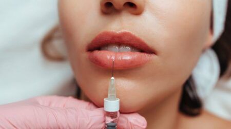 Ін'єкційна косметологія губ в Києві: що це таке та які переваги має процедура