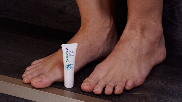 Как действует крем Spirularin VS при лечении бородавок и мозолей Как действует крем Spirularin VS при лечении бородавок и мозолей