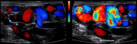 Проба Вальсальвы при варикоцеле