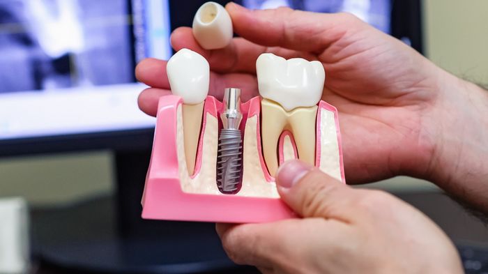 Имплантация зубов: что следует знать