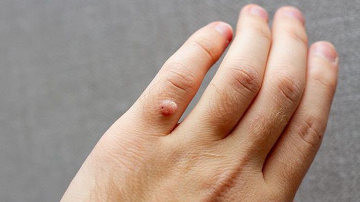 Бородавки — это вирус. Врач рассказала, кто в зоне риска и как их не подцепить Бородавки — это вирус. Врач рассказала, кто в зоне риска и как их не подцепить