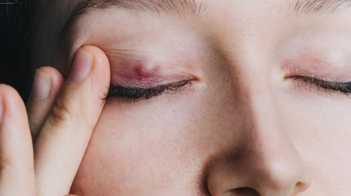 Халязион: причины, симптомы и лечение Халязион: причины, симптомы и лечение