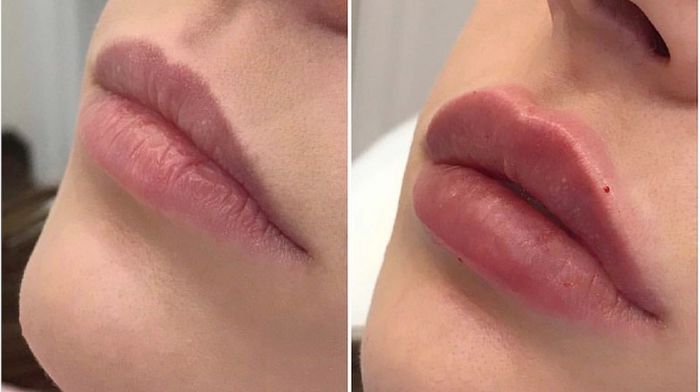 Увеличение губ филлерами: что нужно знать