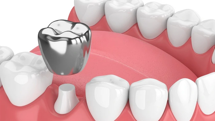 В каких случаях требуется установка коронки? В каких случаях требуется установка коронки?