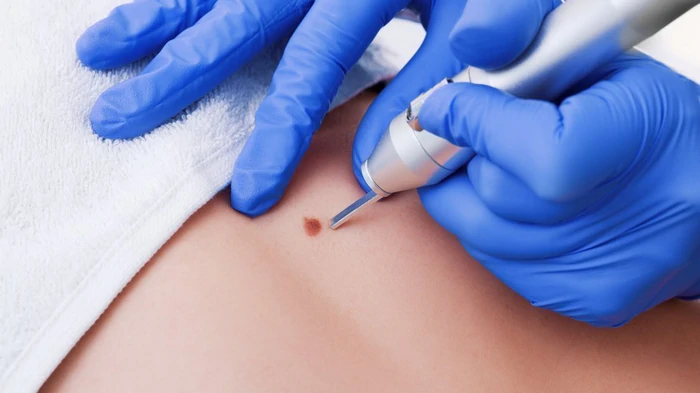 Видалення родимок в медичному центрі «Ангіолайт» — сучасний підхід до здоров'я шкіри