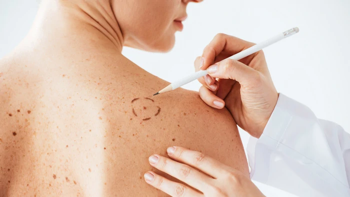 Видалення родимок