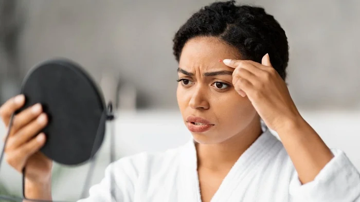 Самостоятельное выдавливание прыщей: почему этого нельзя делать Самостоятельное выдавливание прыщей: почему этого нельзя делать