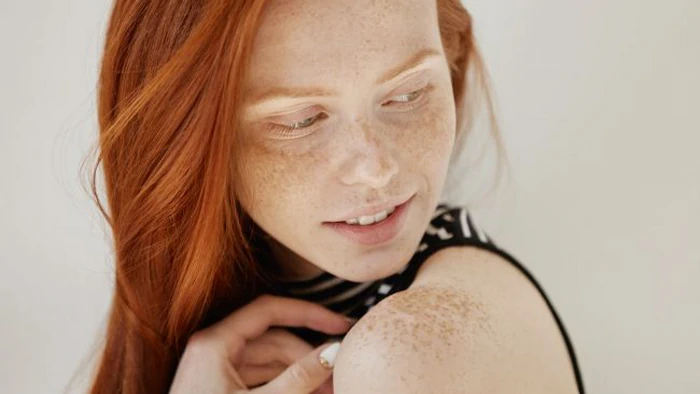 Веснушки или пигментация: как правильно понять, что на коже Веснушки или пигментация: как правильно понять, что на коже