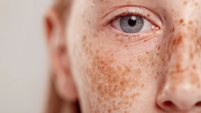 Как избавиться от пигментных пятен: советы дерматолога