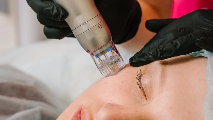 RF-лифтинг лица